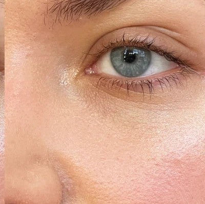 Eye Therapy Patch — après